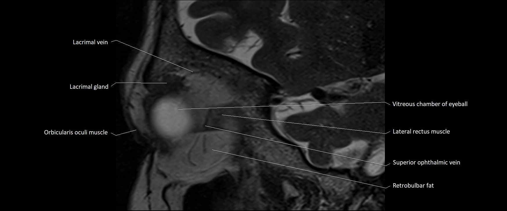 MRI Orbit sagittal cross sectional anatomy 3T image 15.webp